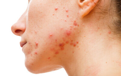 5 Benefits of Visiting an Acne Treatment Center