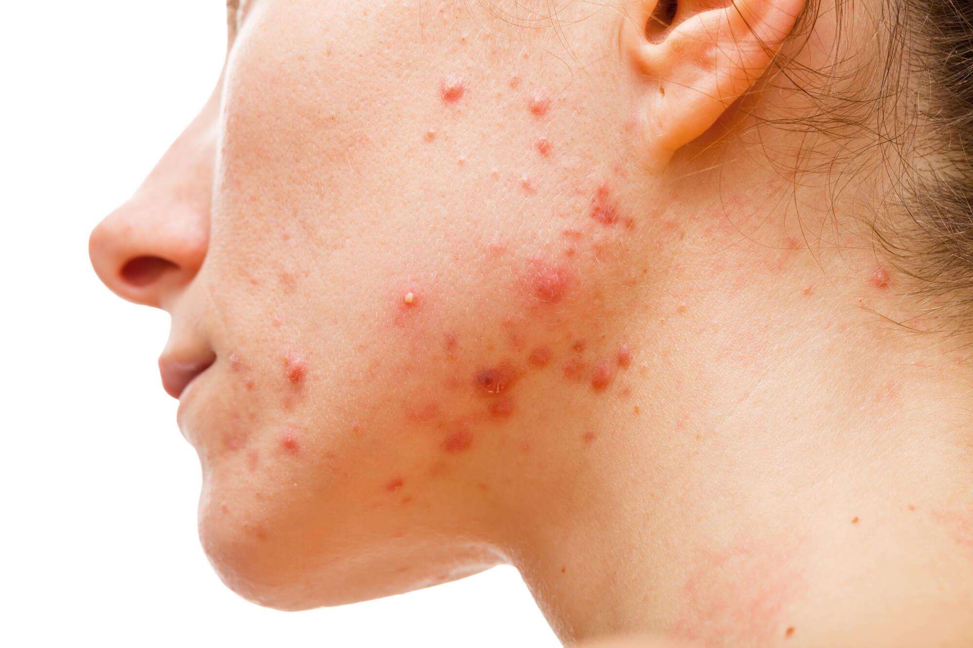 5 Benefits of Visiting an Acne Treatment Center, image size:2000x1333